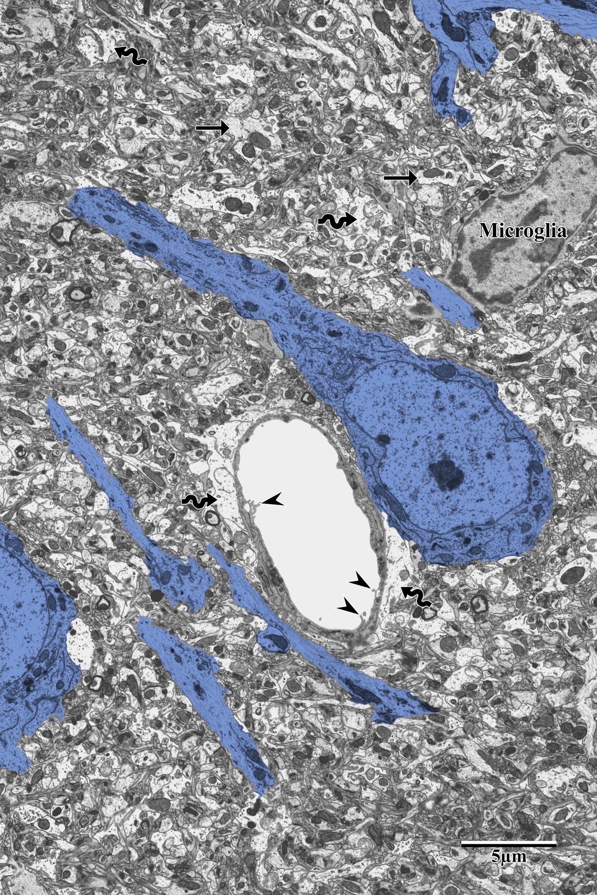 Distal peri-infarct neuron showing early ischemic changes with microglia