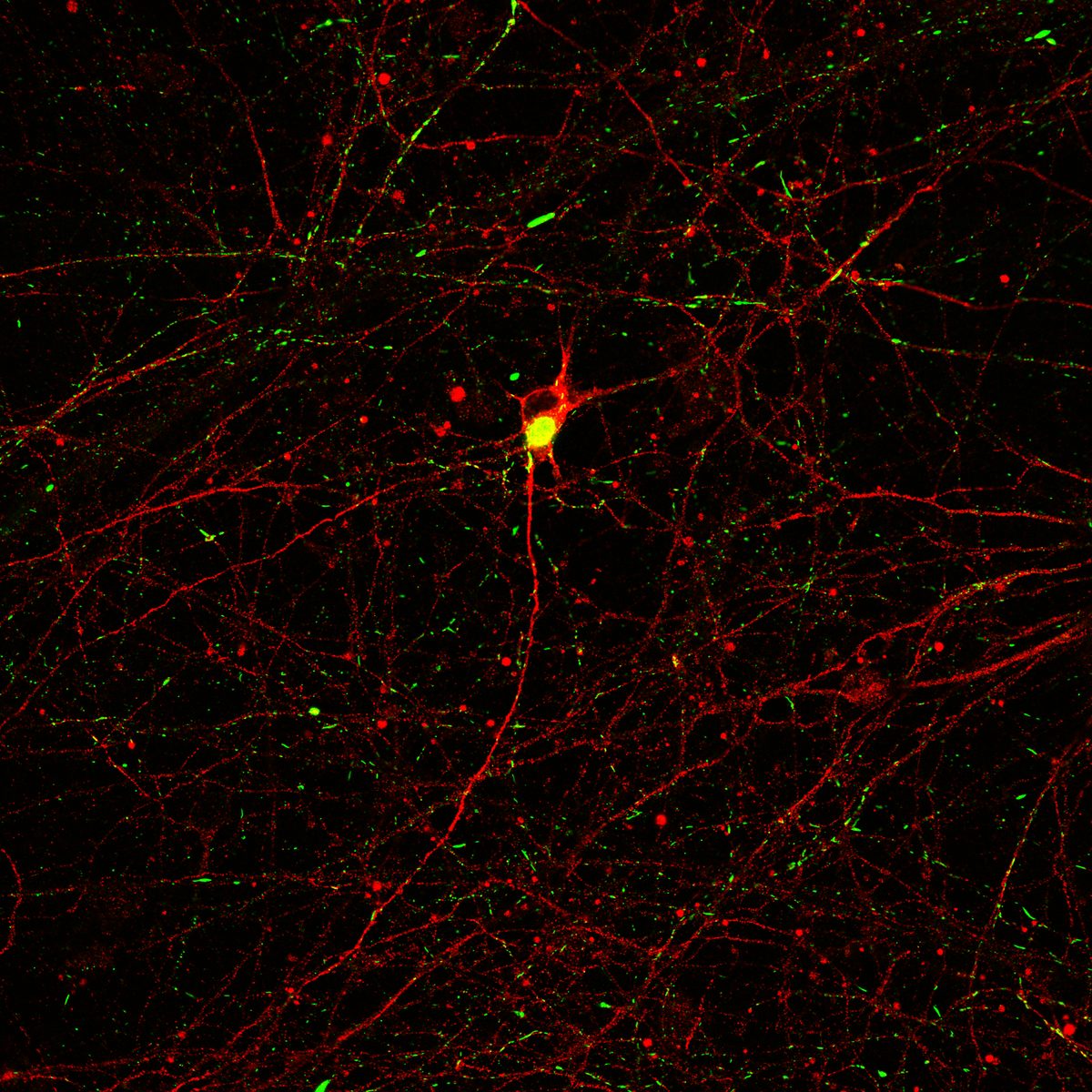 DA neuron with TH, PFF-gold, and pSyn-488 perinuclear inclusion