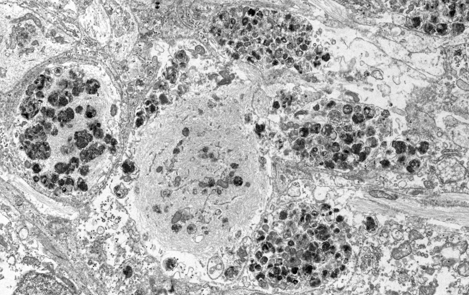 EM: Compact/mature inclusion resembling patient tissue Lewy body