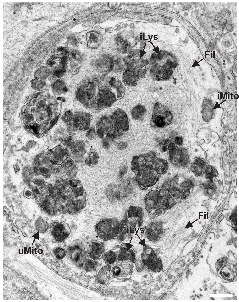 EM: Compact/mature inclusion matching patient tissue Lewy bodies