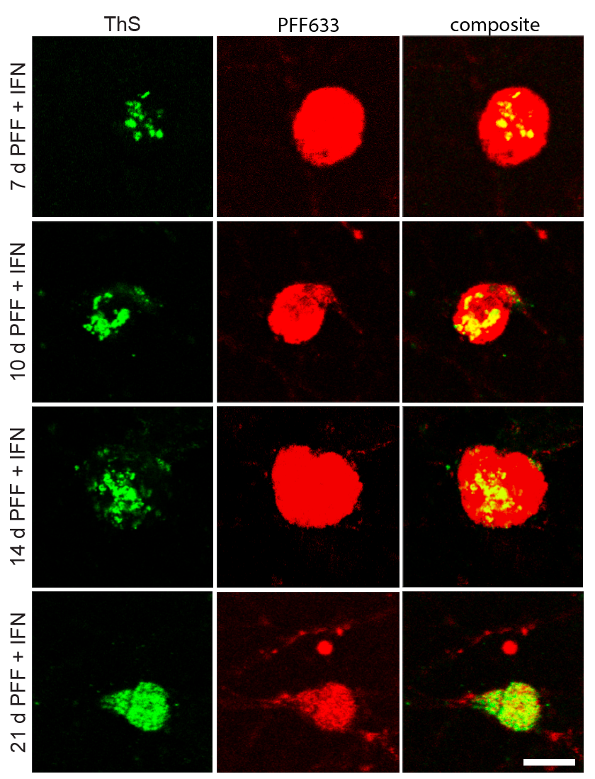 Thioflavin S staining of α-synuclein inclusions in iPSC-derived neurons